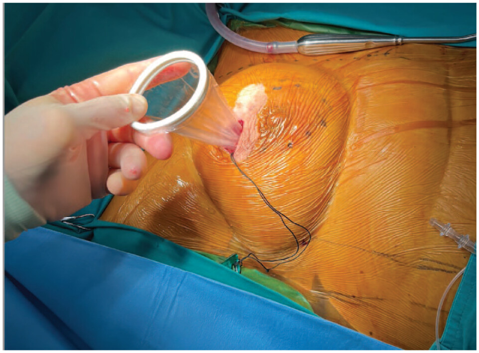 Heart Endoscopy: Procedure and Benefits